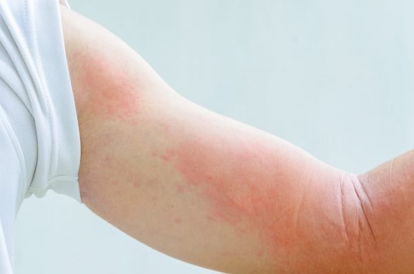 Проявление аллергии на коже ребенка