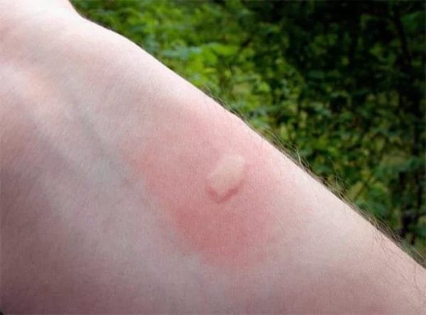 Комариный укус на руке
